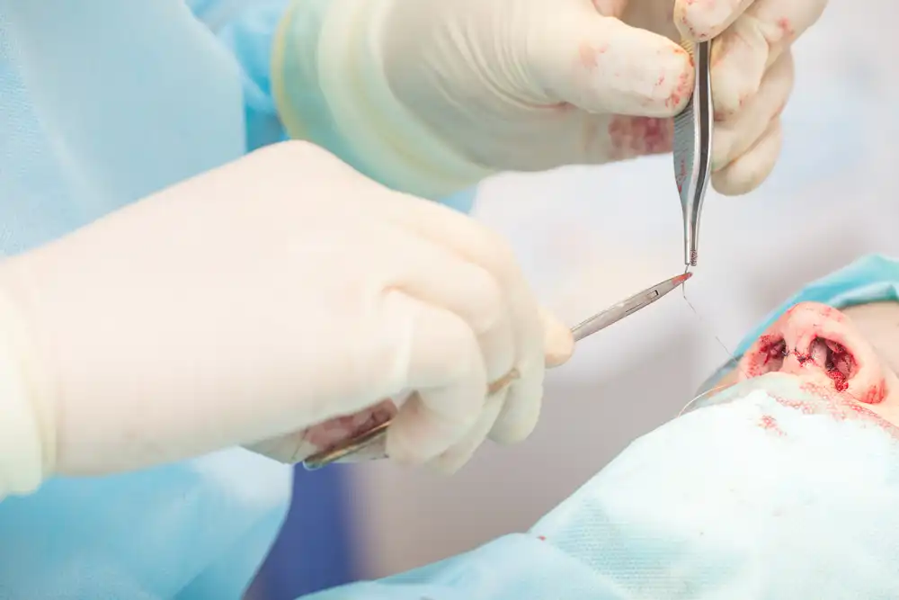 خياطة-تجميلية-للانف