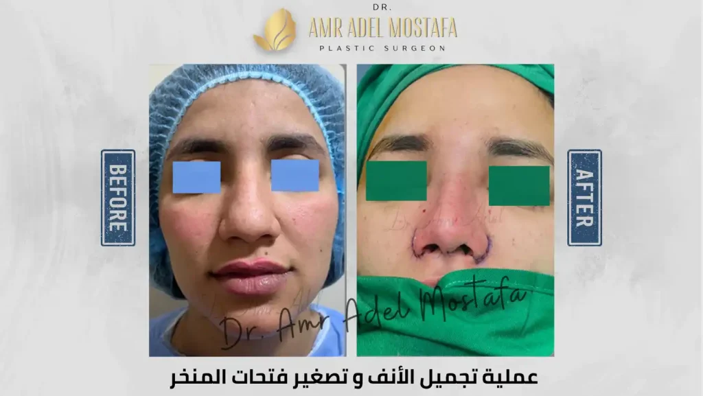 عملية-تجميل-الانف