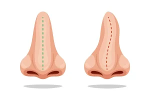 قبل-وبعد-تجميل-الانف