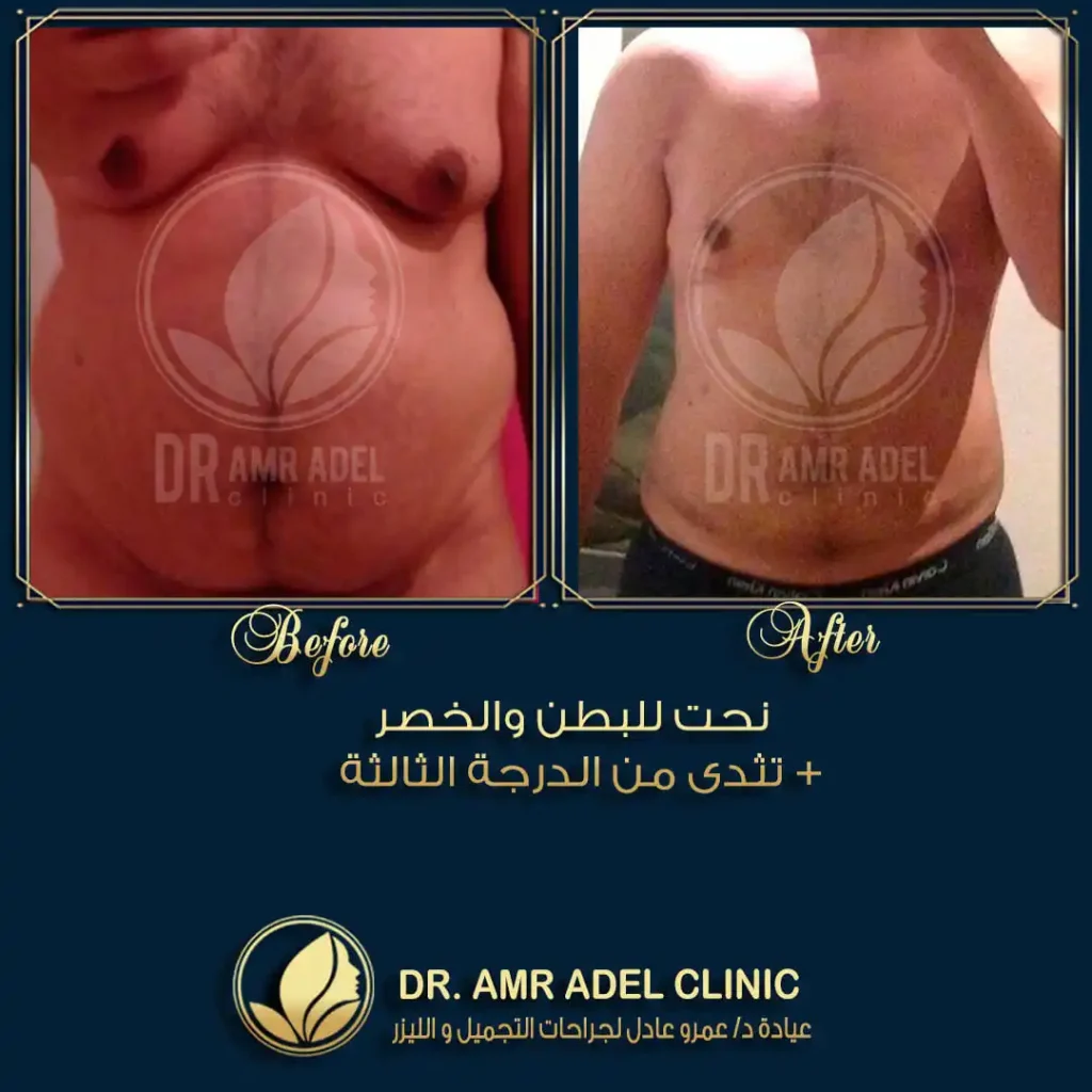 تثدى-درجة-ثالثة