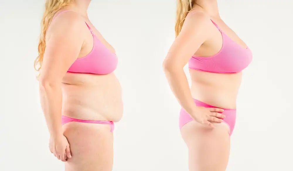 قبل-وبعد-شد-البطن
