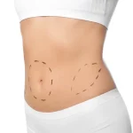 بعد-عملية-شد البطن