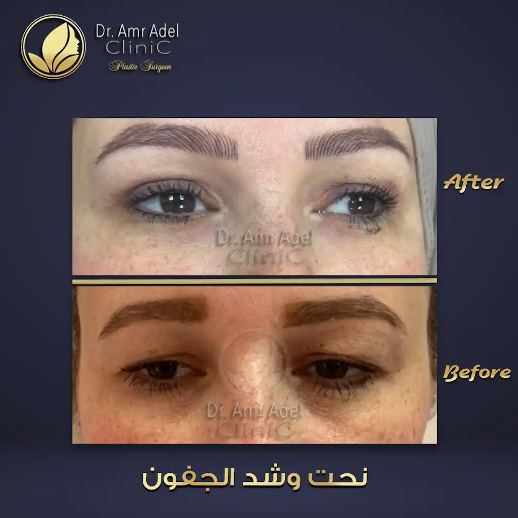 تجميل-الجفون-العلوية