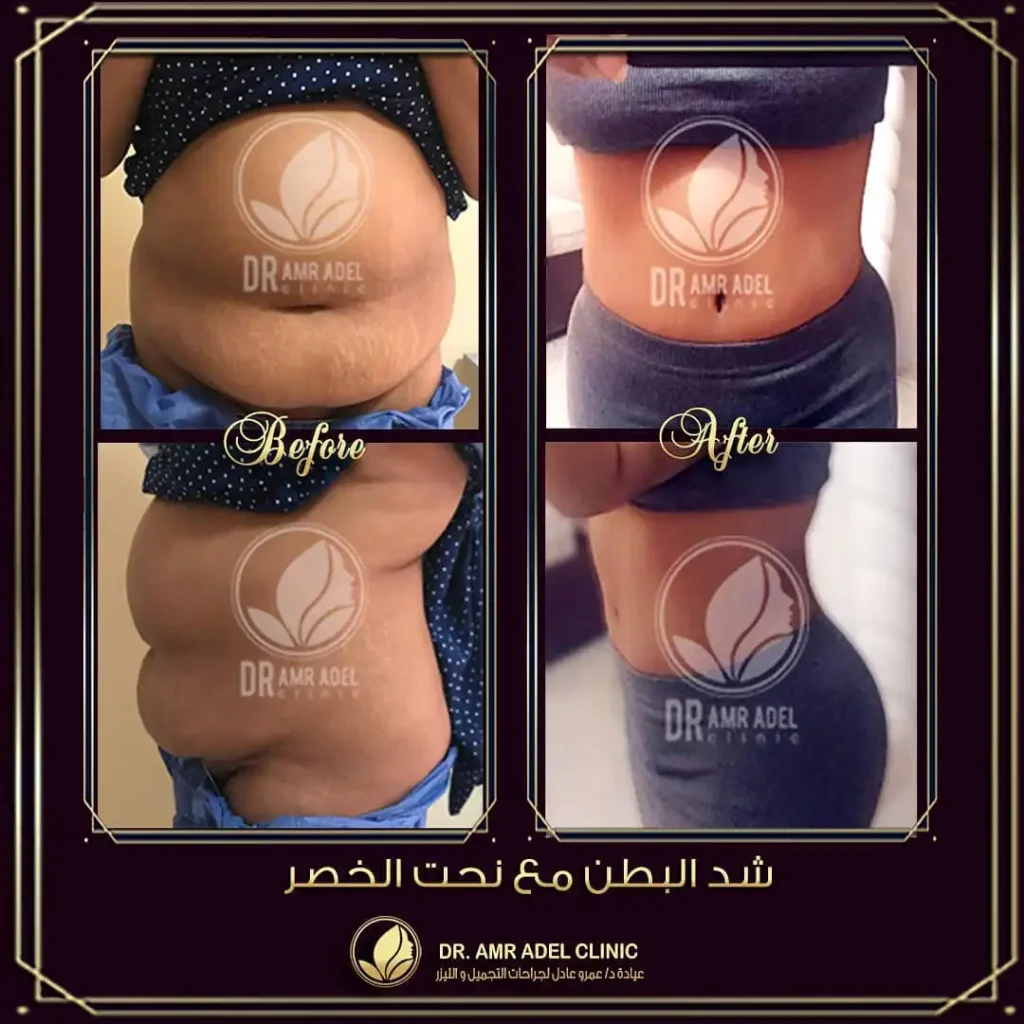 شفط-دهون-البطن