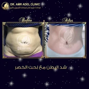 شكل-البطن-بعد-شد-البطن