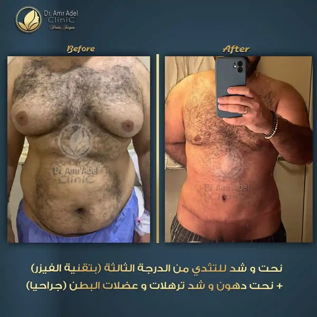 تثدى-درجة-ثالثة