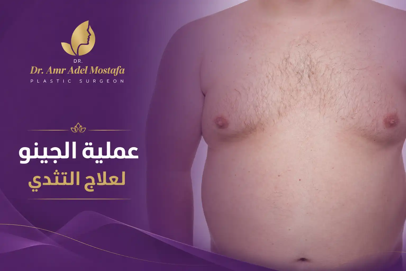 عملية الجينو للتخلص من التثدي عند الرجال فى أسرع وقت