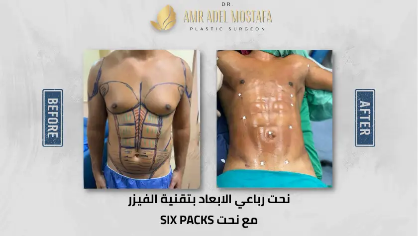 نحت-الجسم-بالفيزر