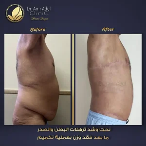 حالة-نجاح-لشد الترهلات