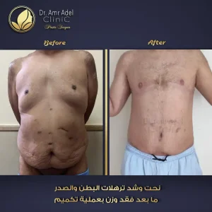شد-ترهلات-الجلد