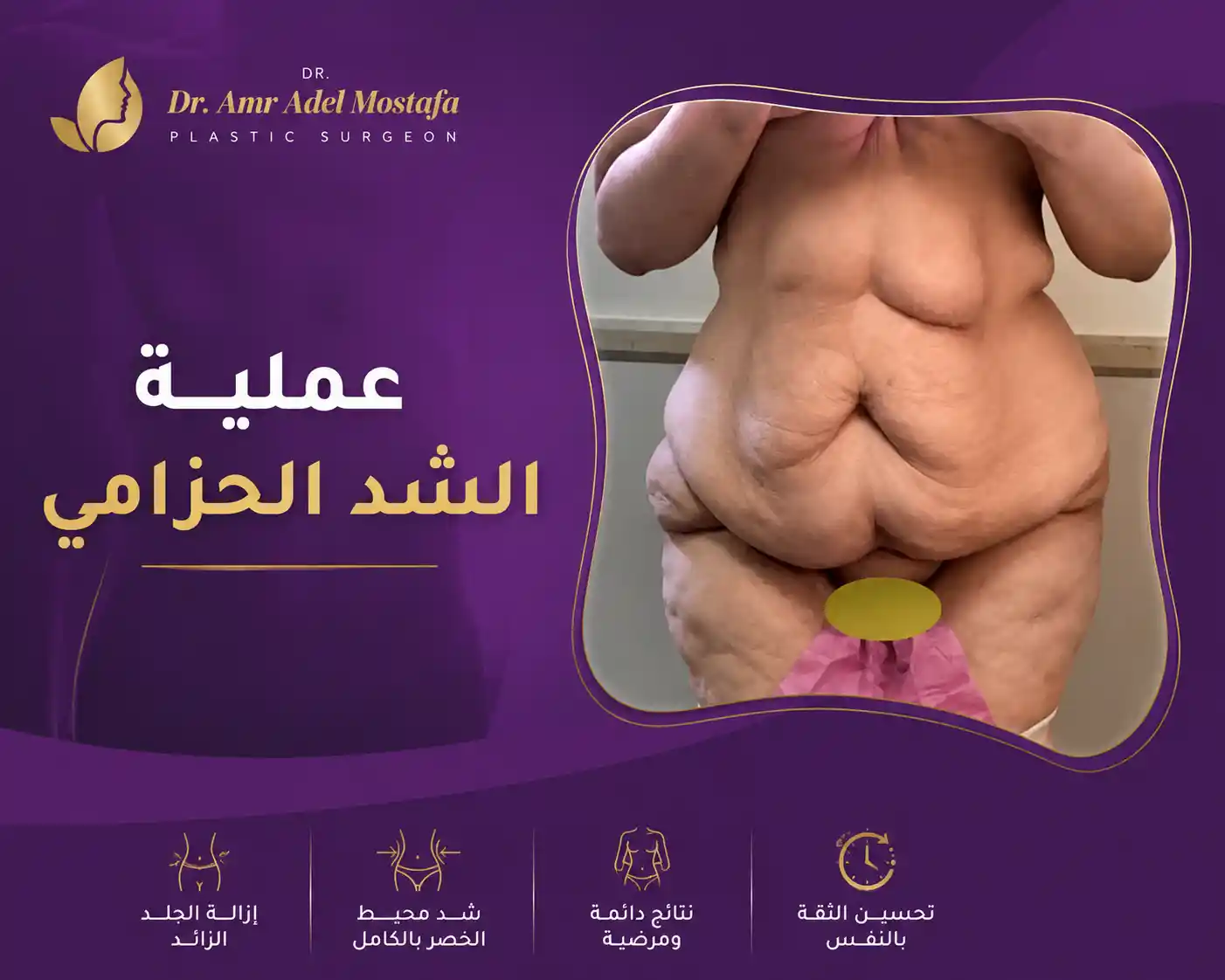 عملية الشد الحزامي لشد ترهل البطن والظهر والأرداف معاً