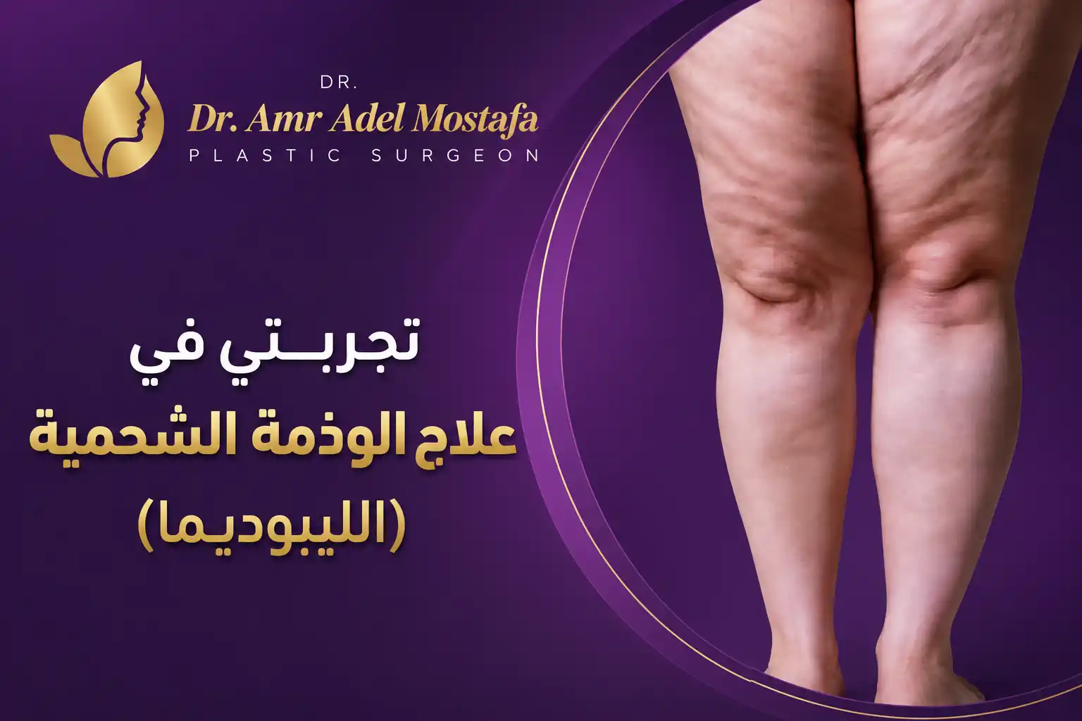 تجربتي فى علاج الوذمة الشحمية (الليبوديما) 2026